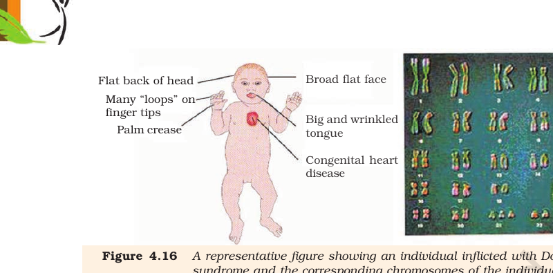 Figure 4.16 Down's syndrome & karyotype